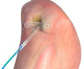 15 Place a probe or hemostats between the tendons and the knee to maintain tension on the grafts as they begin to enter