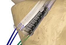 5 Pull the Driver back along the Guide Wire to disengage from the Tibial Sheaths. Verify the tabs are fully seated against the cortex.