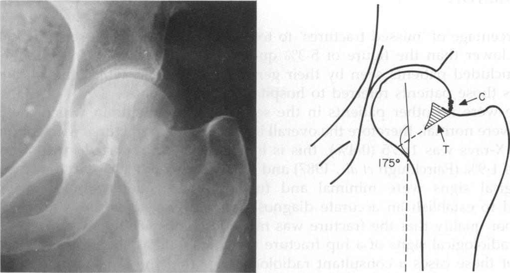 Missed hip fractures 25 Fig. 1. Impacted subcapital hip fracture, showing the increase in trabeculae angle to 1750 with a break in the trabeculae at the site of the fracture.