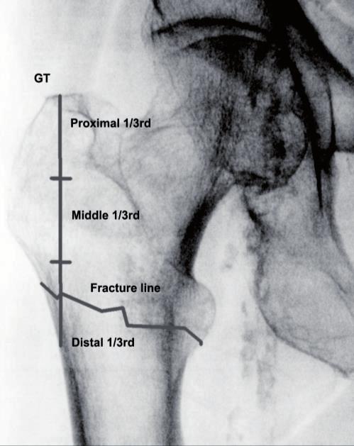 26 Chapter 2 Figure 3 Lateral wall integrity: Fracture line crossing proximal, middle and distal one-third of the greater trochanter. Results There were 31 male and 133 female patients.