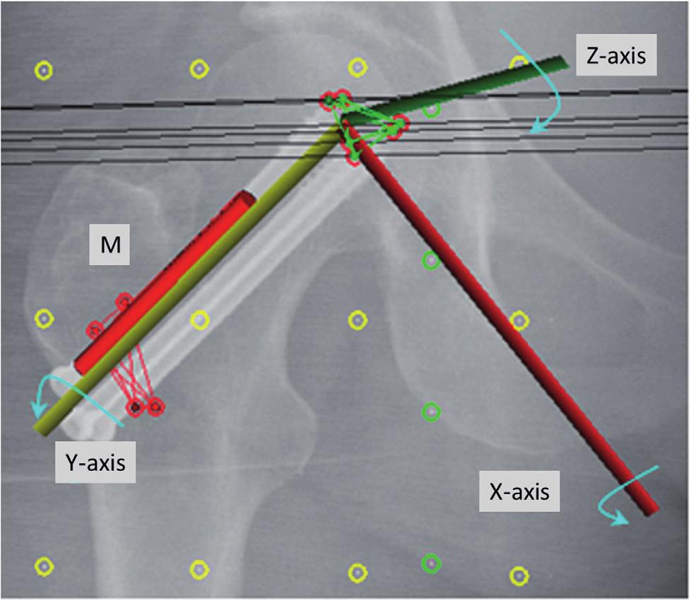 Chapter 7 85 Figure 2 Radiostereometric analysis radiograph presenting head and shaft markers (red dots).