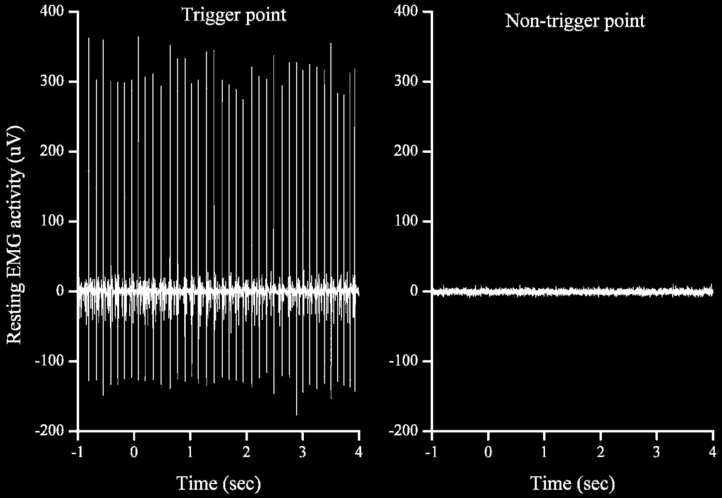 Figure 1 A typical example of resting electromyographic (EMG) activity at a myofascial trigger point and a non-trigger point. the L 4 5.