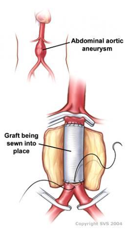 Vascular surgeons manage veins and arteries in every part of the body except the brain and the heart. For example, vascular surgeons handle blocked carotid arteries in the neck.