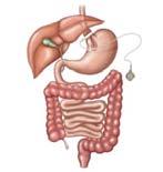 intestine; performed with or without duodenal switch % of procedures performed 40% 50% 5% 5% 15 Comparative Treatment Outcomes 80.0% 70.0% 60.