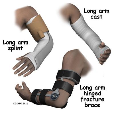 tight swelling increases the pain after the fracture and removing the blood can reduce the pain.