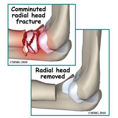 Surgery Surgical treatment of radial head fractures usually involves making an incision over the lateral (outside) portion of the elbow, putting the fracture fragments back in their normal position,