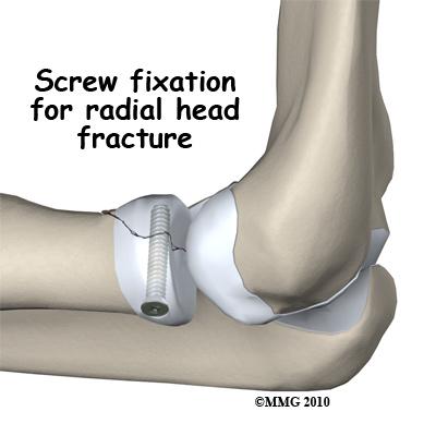 The fracture fragments are generally very small and the most common type of fixation are small metal pins or metal screws to hold the fragments together.
