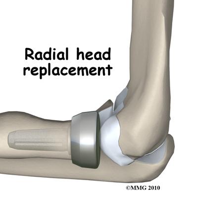 If there are multiple fracture fragments that the surgeon decides cannot be reassembled and held together with any hope of success, a radial head excision may be recommended.