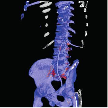(and color code) the calculi and stent, compared to concurrent conventional CT images, while Figure 2 demonstrates the enhanced facility afforded by the 3D reconstruction to identify stone burden,