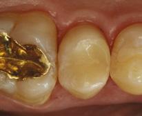 protects fillings against fracture and secondary caries still the main reasons for direct restoration failure.
