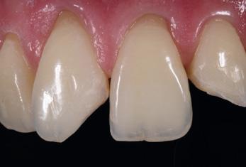 Opaque dentin Universal Incisaltranslucent Incisalopalescent A3.5 Venus Pearl composite The beauty of longlasting aesthetics.