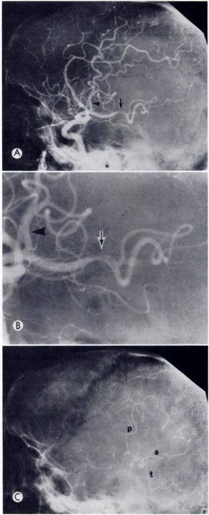 VOL. is6, No. 3 Embolic Occlusion of Middle Cerebral Artery 577 TABLE I ANGIOGRAPHIC LOCALIZATION OF MIDDLE CEREBRAL OCCLUSIONS. Location S Prior to origin of striate arteries. ;.