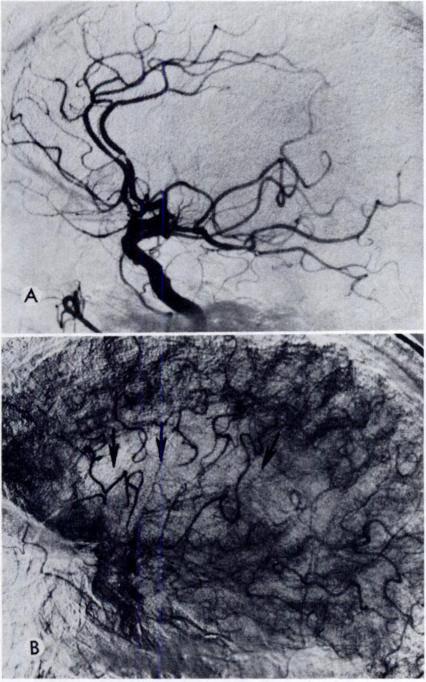 MATERIAL Eighty-four angiographic examples of occlusion of the MCA or its branches were reviewed (Table I) and from this group 14 satisfying our angiographic criteria of division occlusion were