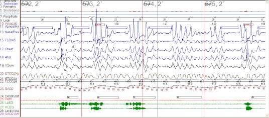 obstructive sleep apnea Multiple previous PSG s showing moderate to severe OSA Physical Exam / Direct laryngoscopy Micrognathia