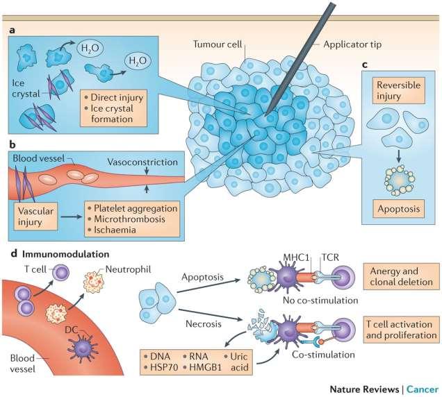 Mechanisms of tumor cell death in local therapies Cryoablation Cryoablation Radiotherapy Radioembolization