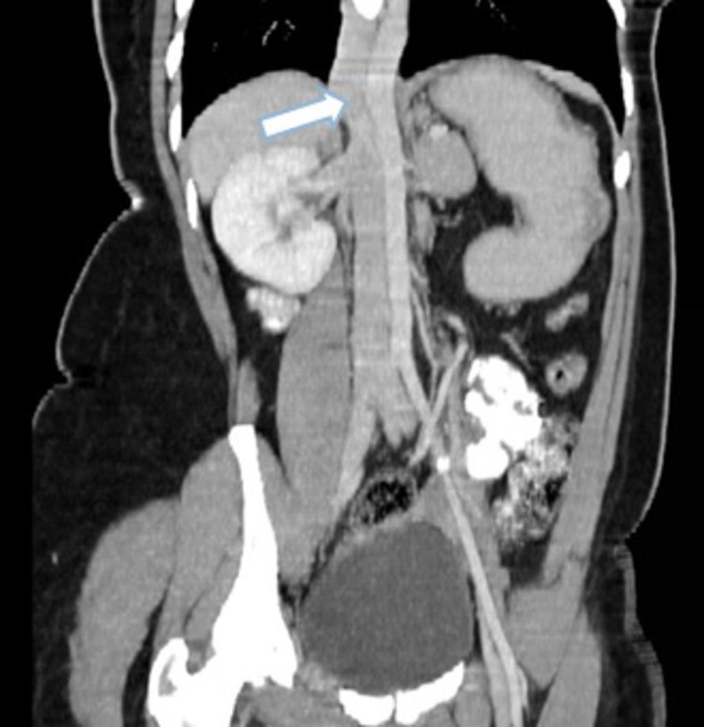 Fig.: Coronal CT maximum intensity projection with IV contrast showing azygos