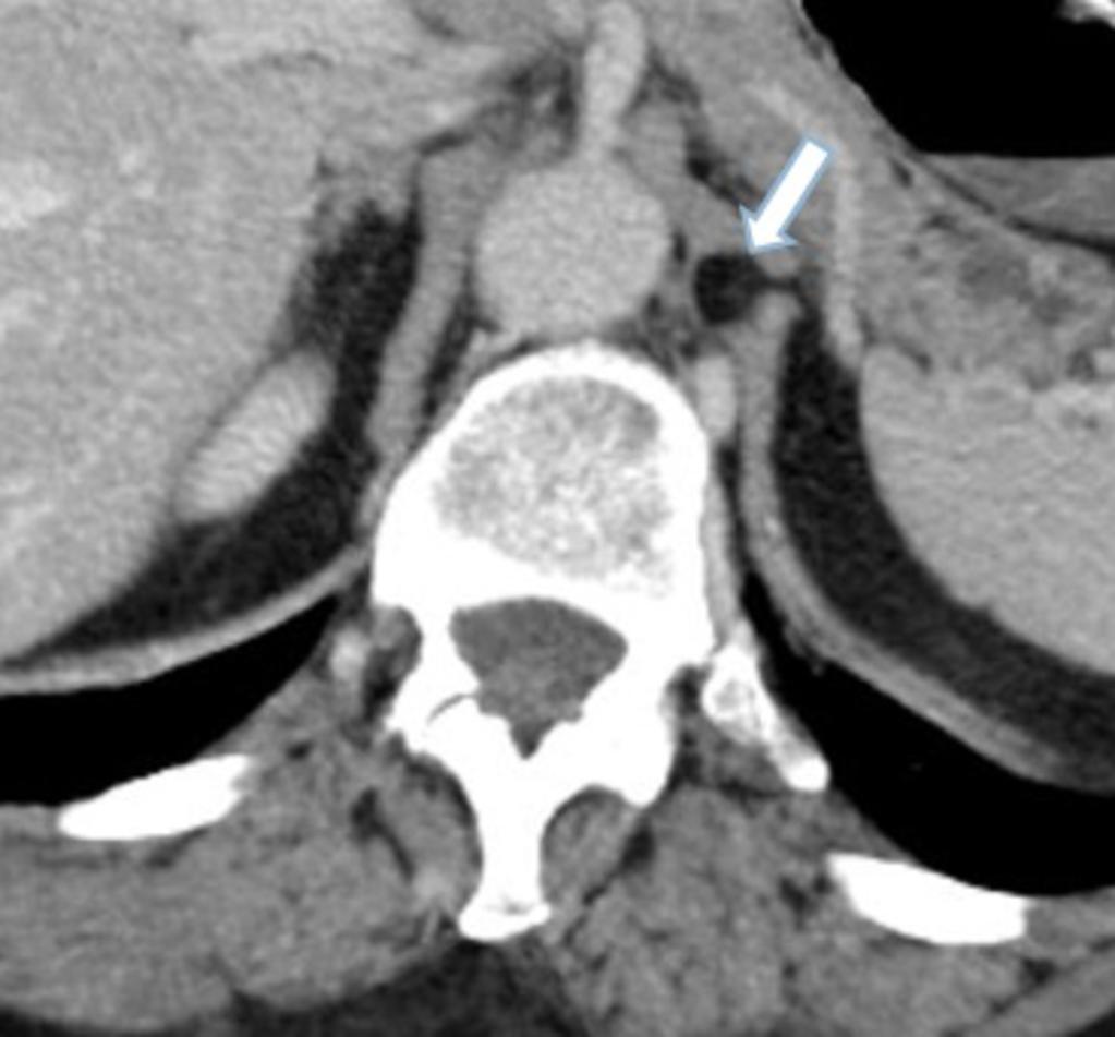 Fig.: Axial contrast enhanced CT showing a subcentimetre