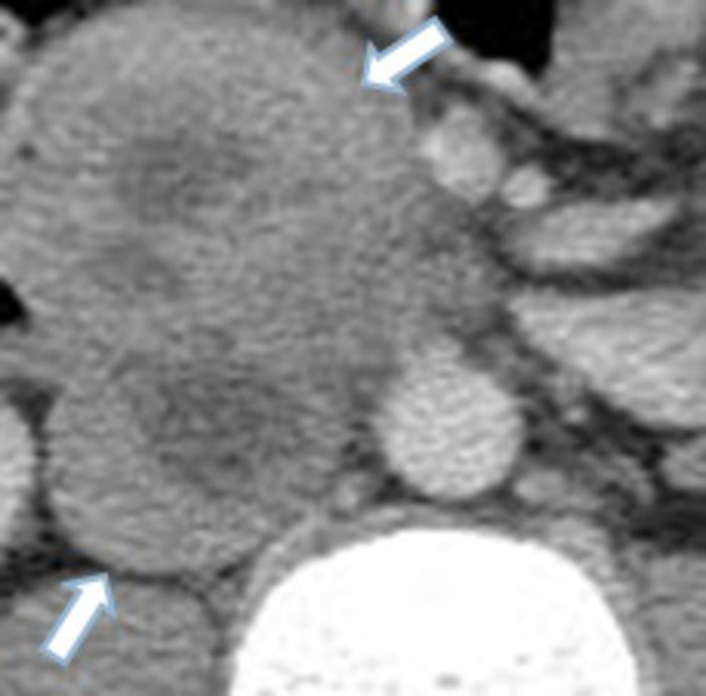 Fig.: Axial contrast enhanced CT with a large mass (arrows) invading the retrocrural space in a patient with metastatic
