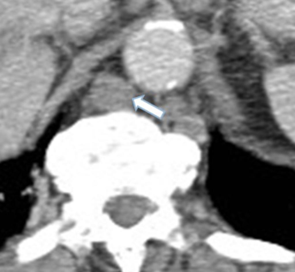 Fig.: Axial contrast enhanced CT with enlarged lymph nodes (arrow) in the retrocrural space in a patient with metastatic ovarian carcinoma