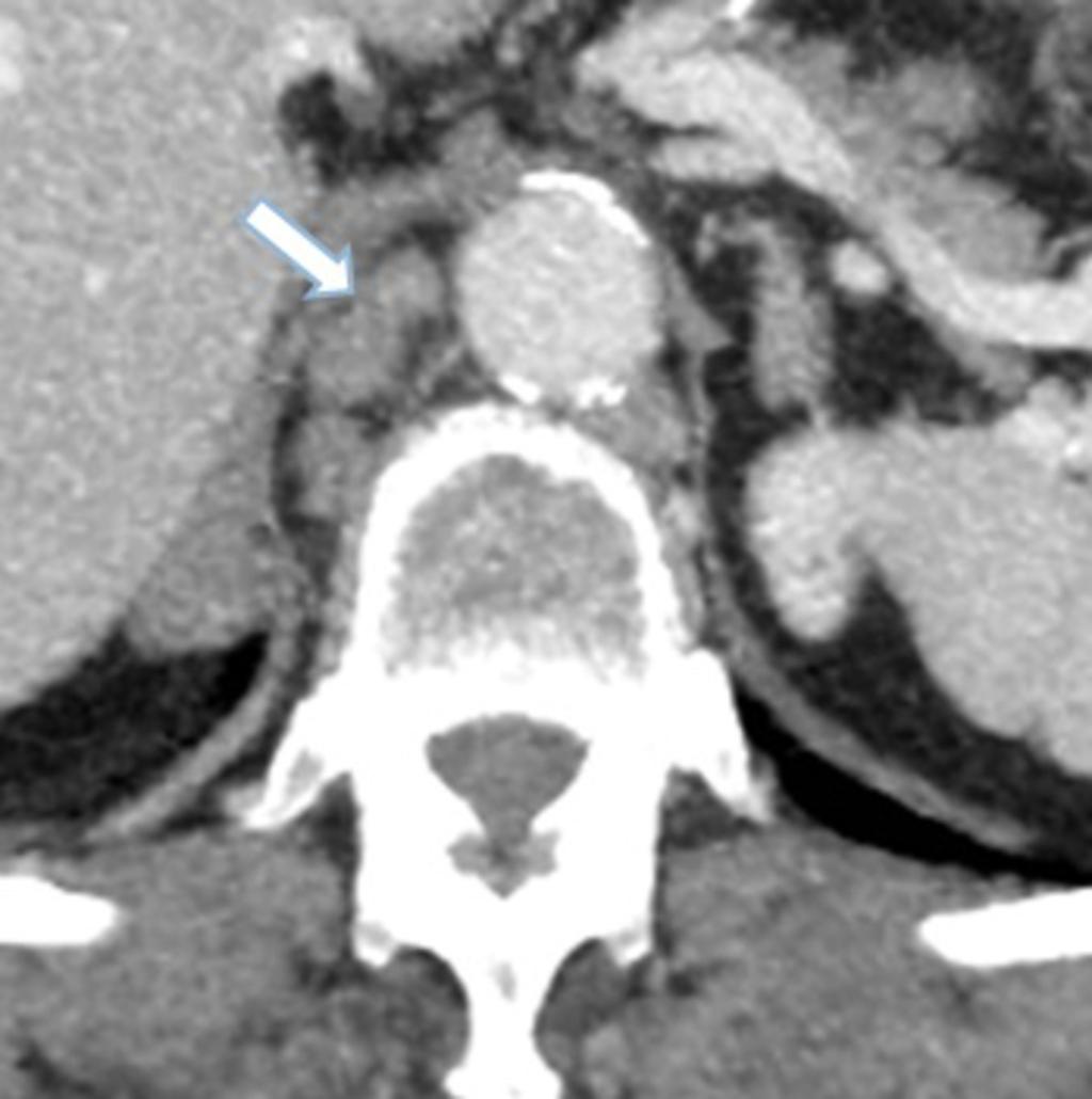 Fig.: Axial contrast enhanced CT with several small lymph nodes (arrow) in