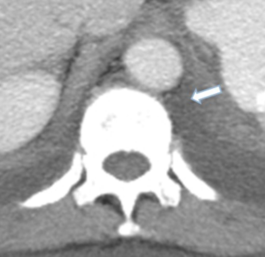 Fig.: Axial contrast enhanced CT showing free fluid (arrow) in the