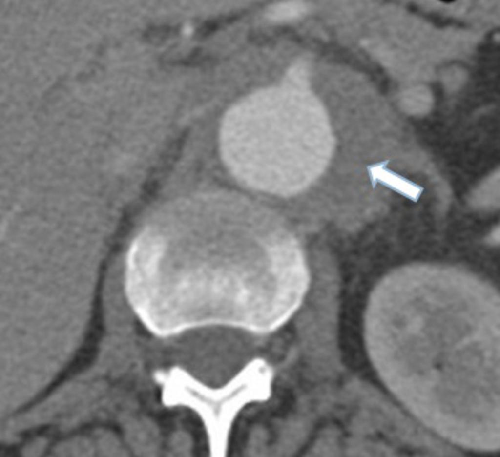 Fig.: Axial contrast enhanced CT showing diffuse inflammation of the