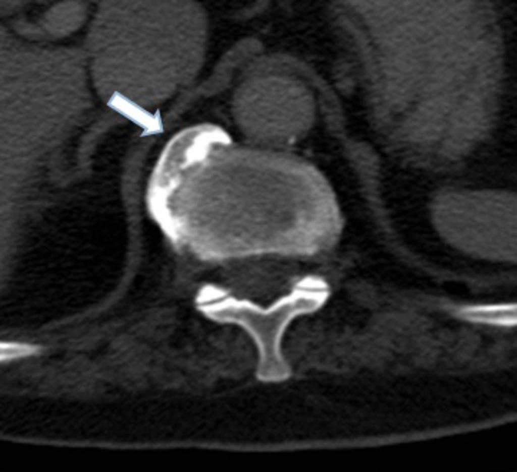 Fig.: Axial contrast enhanced CT demonstrating spondylosis deformans (arrow) on the right anterolateral aspect of T12 with displacement of the right crus Vascular