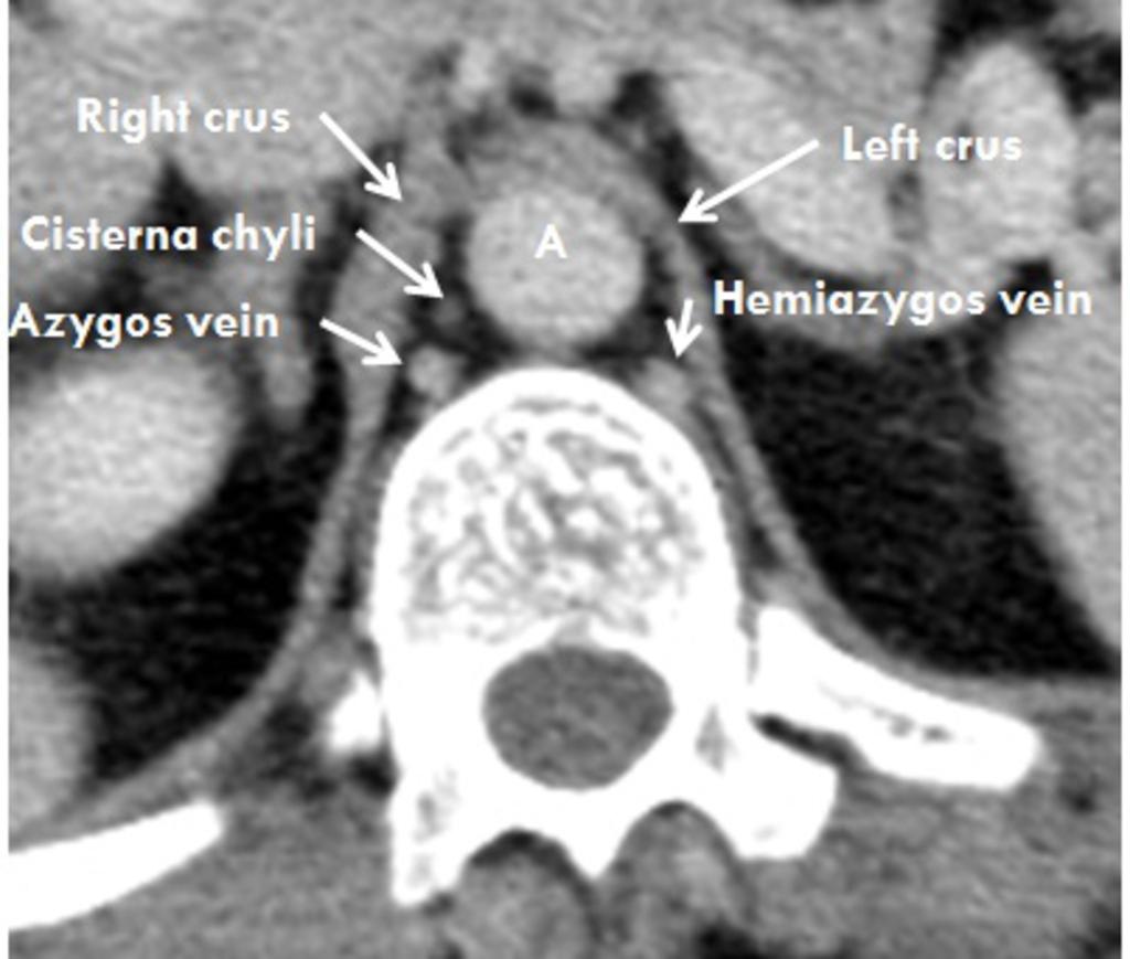 Fig.: Axial contrast enhanced CT outlining the normal anatomy of the retrocrural space and its contents Aorta The aorta is the largest structure within the retrocrural space At the