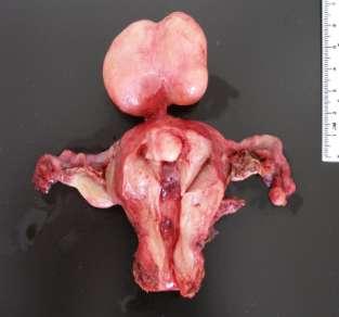How common are (fibroids) leiomyomata?