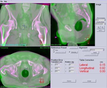 CBCT for Localization of Prostate SBRT Patients