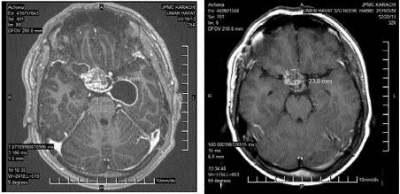 7 Stereotactic radiosurgery (SRS), particularly γ- Knife surgery (GKS), affords excellent local tumour control for between 1 and 10 brain metastases.