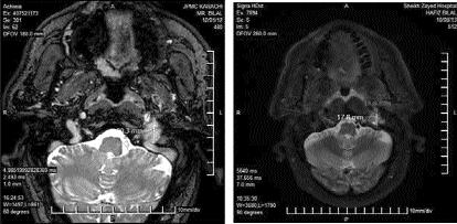 Figure-10: Arteriovenous malformation pre-and post-stereotactic radiosurgery.