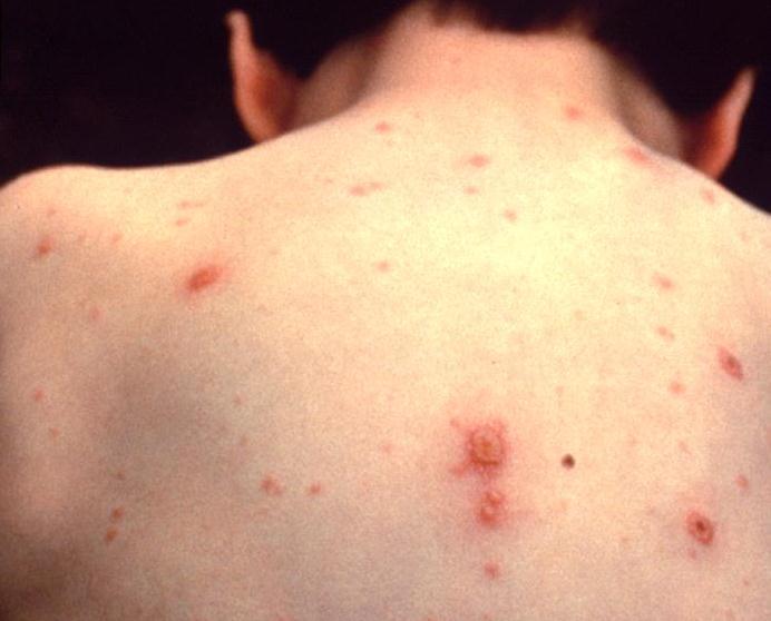 Varicella Disease Considerations: Varicella disease is highly communicable Birth before 1980 is only presumptive