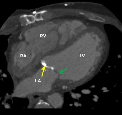 Echocardiographic features of radiation-induced valvular disease Left sided