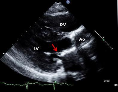 of Ao root, AV annulus and leaflets, and aorticmitral inter-valvular fibrosa