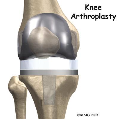 Introduction A painful knee can severely affect your ability to lead a full, active life.