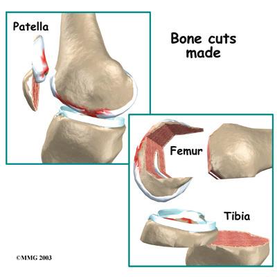 patellar (kneecap) portion of the prosthesis is commonly cemented into place.