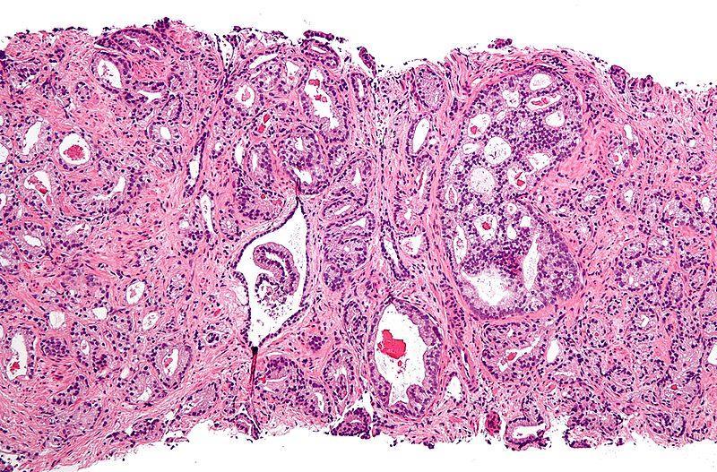 DD Prostatic Adenocarcinoma More homogenous glands Cystic and atrophic patterns uncommon When involving
