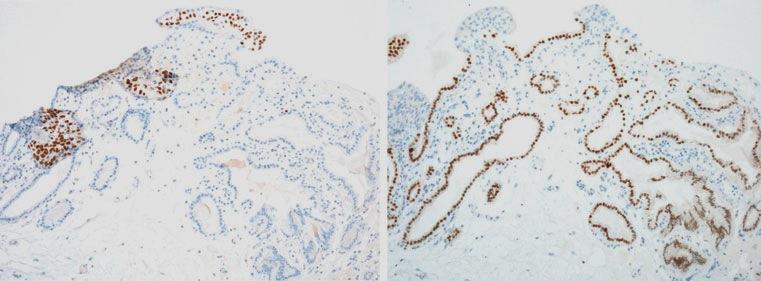 Immunhistochemical findings p63 - in NA PAX-8 + in NA (100%) In NA and in urothelium, staining