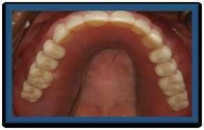 close to natural teeth Traditional Dentures are bulky and rely on suction