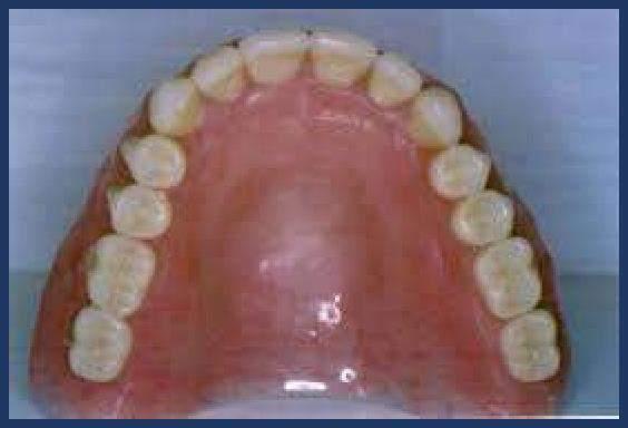 appliance will increase the bone loss process Speech Concerns Bulky dentures interfere with patient speech patterns Overall Appearance