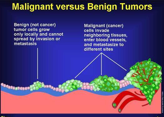 Neoplasms/Tumors Abnormal growth of new tissue Are either; Benign