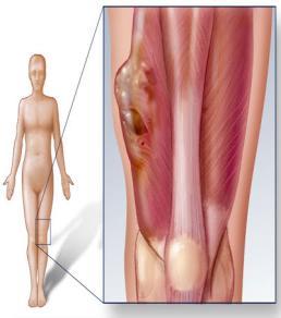 Sarcomas Originate from musculoskeletal system Can also spread to other tissues of the body