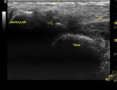 in tendon ruptures Cause of PT