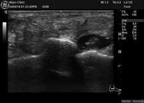 tendinopathy and spring ligament