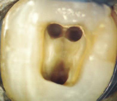 Figure 4 demonstrates a case where an access cavity was prepared on a lower fist molar. It is evident that the preparation allows for straight-line access into all the root canals.