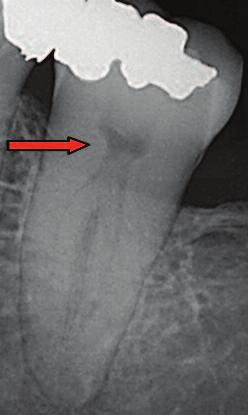 Figure 5 shows a radiograph of a lower second molar where a coronal interference is clearly visible (arrow), obstructing the entrance of the mesial root canal.