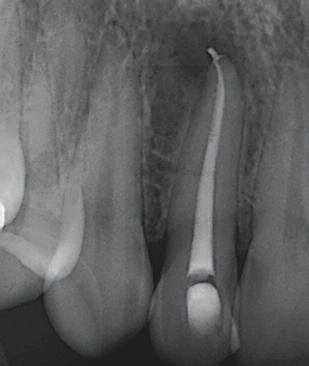 from the root canal. The flutes of the file were cleaned and the root canal irrigated with 3.5% sodium hypochlorite.