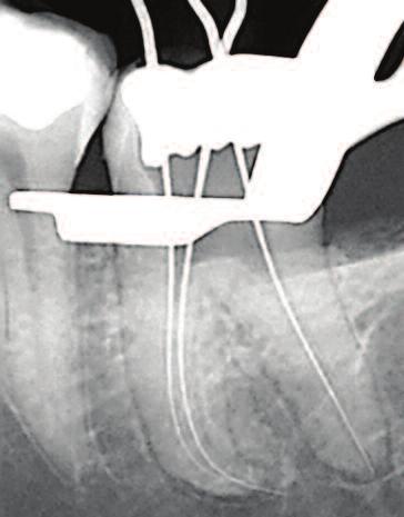 After removal of the caries and access cavity preparation, root canal patency and length determination was established (Figure 14b).