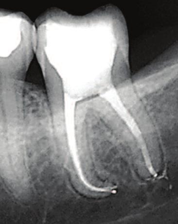 Root canal preparation was done using ProTaper Universal rotary instruments (Dentsply/Maillefer) and obturation was done with AH Plus Root Canal Cement (Dentsply/Maillefer) in conjuction with F2